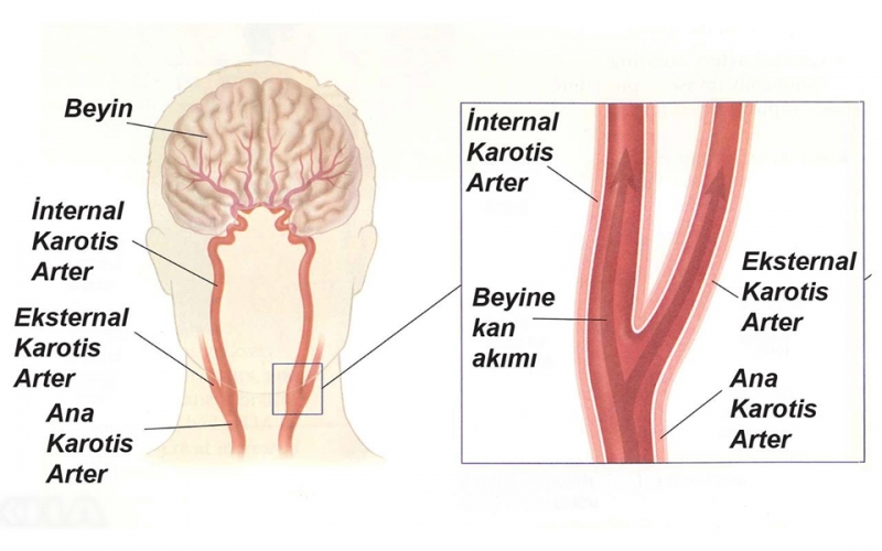 Şah Damarı Tıkanıklığı Felce Neden Olabilir   